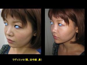 目の下のたるみ、目のくまでお悩みの方、切らずに完璧に解決します。TCB-R法　手術直後　症例写真