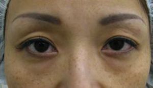 目の下のたるみ、目のくまでお悩みの方、切らずに完璧に解決します。TCB-R法　手術直後　症例写真