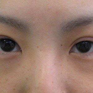 目の下のたるみ、目のくまでお悩みの方、切らずに完璧に解決します。TCB-R法　手術直後　症例写真