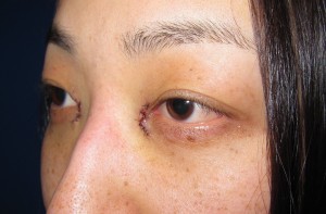 目の下のたるみ、目のくまでお悩みの方、切らずに完璧に解決します。TCB-R法　手術直後　症例写真