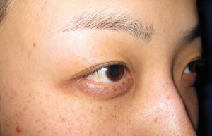 目の下のたるみ、目のくまでお悩みの方、切らずに完璧に解決します。TCB-R法　手術直後　症例写真