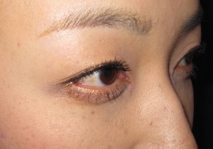 目の下のたるみ、目のくまでお悩みの方、切らずに完璧に解決します。TCB-R法　手術直後　症例写真