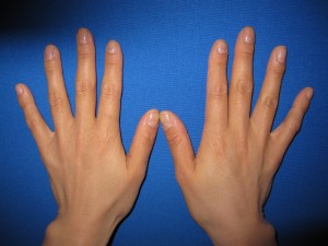 目の下のたるみ、目のくまでお悩みの方、切らずに完璧に解決します。TCB-R法　手術直後　症例写真