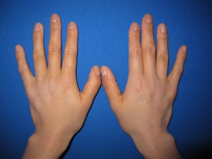目の下のたるみ、目のくまでお悩みの方、切らずに完璧に解決します。TCB-R法　手術直後　症例写真