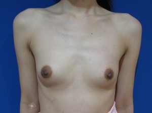 目の下のたるみ、目のくまでお悩みの方、切らずに完璧に解決します。TCB-R法　手術直後　症例写真