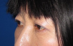 目の下のたるみ、目のくまでお悩みの方、切らずに完璧に解決します。TCB-R法　手術直後　症例写真