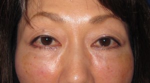 目の下のたるみ、目のくまでお悩みの方、切らずに完璧に解決します。TCB-R法　手術直後　症例写真