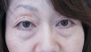 目の下のたるみ、目のくまでお悩みの方、切らずに完璧に解決します。TCB-R法　手術直後　症例写真