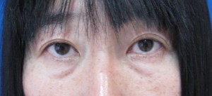 目の下のたるみ、目のくまでお悩みの方、切らずに完璧に解決します。TCB-R法　手術直後　症例写真