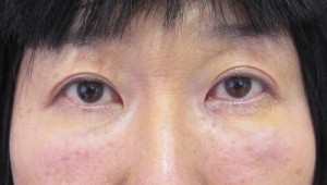 目の下のたるみ、目のくまでお悩みの方、切らずに完璧に解決します。TCB-R法　手術直後　症例写真
