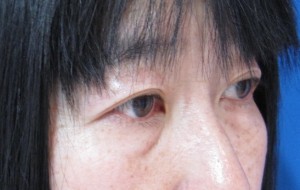 目の下のたるみ、目のくまでお悩みの方、切らずに完璧に解決します。TCB-R法　手術直後　症例写真