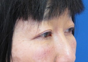 目の下のたるみ、目のくまでお悩みの方、切らずに完璧に解決します。TCB-R法　手術直後　症例写真