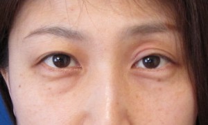 目の下のたるみ、目のくまでお悩みの方、切らずに完璧に解決します。TCB-R法　手術直後　症例写真