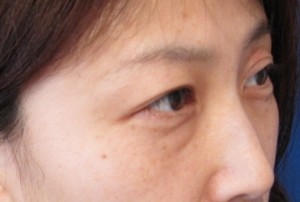 目の下のたるみ、目のくまでお悩みの方、切らずに完璧に解決します。TCB-R法　手術直後　症例写真