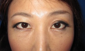 目の下のたるみ、目のくまでお悩みの方、切らずに完璧に解決します。TCB-R法　手術直後　症例写真