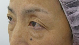 目の下のたるみ、目のくまでお悩みの方、切らずに完璧に解決します。TCB-R法　手術直後　症例写真