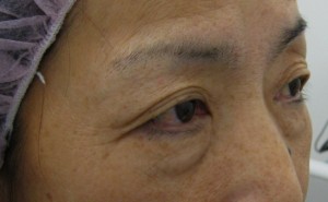 目の下のたるみ、目のくまでお悩みの方、切らずに完璧に解決します。TCB-R法 手術直後 症例写真