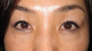 目の下のたるみ、目のくまでお悩みの方、切らずに完璧に解決します。TCB-R法　手術直後　症例写真
