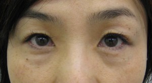 目の下のたるみ、目のくまでお悩みの方、切らずに完璧に解決します。TCB-R法　手術直後　症例写真