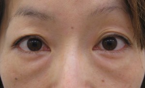 目の下のたるみ、目のくまでお悩みの方、切らずに完璧に解決します。TCB-R法　手術直後　症例写真