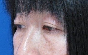 目の下のたるみ、目のくまでお悩みの方、切らずに完璧に解決します。TCB-R法　手術直後　症例写真