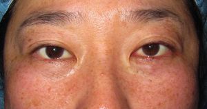 目の下のたるみ、目のくまでお悩みの方、切らずに完璧に解決します。TCB-R法　手術直後　症例写真