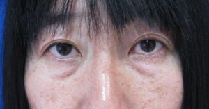 目の下のたるみ、目のくまでお悩みの方、切らずに完璧に解決します。TCB-R法　手術直後　症例写真