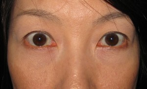 目の下のたるみ、目のくまでお悩みの方、切らずに完璧に解決します。TCB-R法 手術直後 症例写真