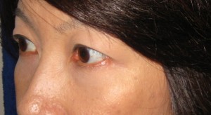 目の下のたるみ、目のくまでお悩みの方、切らずに完璧に解決します。TCB-R法 手術直後 症例写真