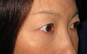 目の下のたるみ、目のくまでお悩みの方、切らずに完璧に解決します。TCB-R法 手術直後 症例写真