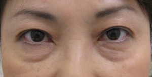 目の下のたるみ、目のくまでお悩みの方、切らずに完璧に解決します。TCB-R法　手術直後　症例写真