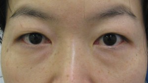 目の下のたるみ、目のくまでお悩みの方、切らずに完璧に解決します。TCB-R法　手術直後　症例写真