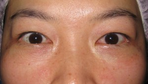 目の下のたるみ、目のくまでお悩みの方、切らずに完璧に解決します。TCB-R法　手術直後　症例写真