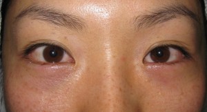 目の下のたるみ、目のくまでお悩みの方、切らずに完璧に解決します。TCB-R法　手術直後　症例写真