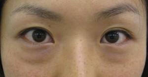 目の下のたるみ、目のくまでお悩みの方、切らずに完璧に解決します。TCB-R法　手術直後　症例写真