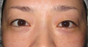 目の下のたるみ、目のくまでお悩みの方、切らずに完璧に解決します。TCB-R法　手術直後　症例写真