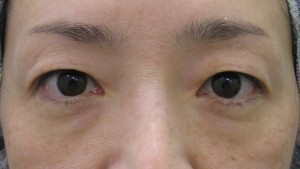 目の下のたるみ、目のくまでお悩みの方、切らずに完璧に解決します。TCB-R法　手術直後　症例写真