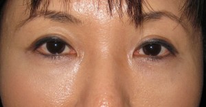 目の下のたるみ、目のくまでお悩みの方、切らずに完璧に解決します。TCB-R法　手術直後　症例写真