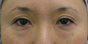 目の下のたるみ、目のくまでお悩みの方、切らずに完璧に解決します。TCB-R法　手術直後　症例写真