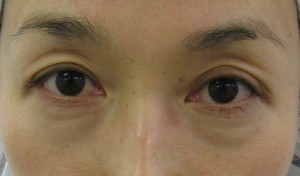 目の下のたるみ、目のくまでお悩みの方、切らずに完璧に解決します。TCB-R法　手術直後　症例写真