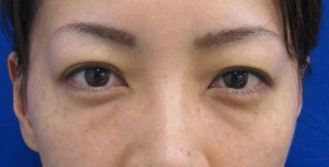 目の下のたるみ、目のくまでお悩みの方、切らずに完璧に解決します。TCB-R法　手術直後　症例写真