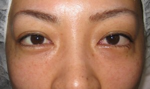 目の下のたるみ、目のくまでお悩みの方、切らずに完璧に解決します。TCB-R法　手術直後　症例写真