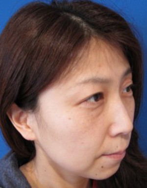 目の下のたるみ、目のくまでお悩みの方、切らずに完璧に解決します。TCB-R法　手術直後　症例写真