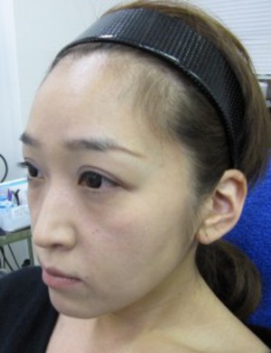 目の下のたるみ、目のくまでお悩みの方、切らずに完璧に解決します。TCB-R法　手術直後　症例写真