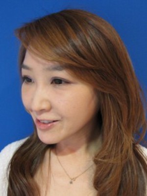 目の下のたるみ、目のくまでお悩みの方、切らずに完璧に解決します。TCB-R法　手術直後　症例写真