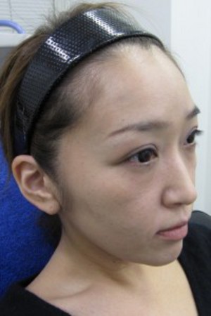 目の下のたるみ、目のくまでお悩みの方、切らずに完璧に解決します。TCB-R法　手術直後　症例写真