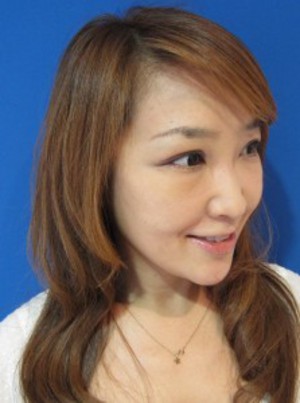 目の下のたるみ、目のくまでお悩みの方、切らずに完璧に解決します。TCB-R法　手術直後　症例写真