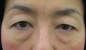 目の下のたるみ、目のくまでお悩みの方、切らずに完璧に解決します。TCB-R法　手術直後　症例写真
