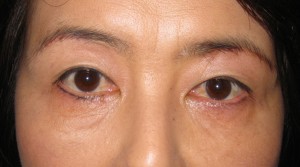 目の下のたるみ、目のくまでお悩みの方、切らずに完璧に解決します。TCB-R法　手術直後　症例写真