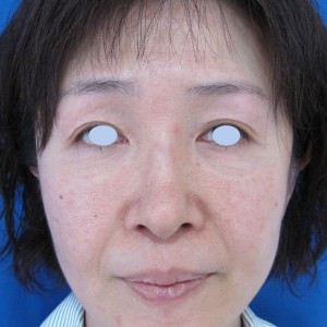 目の下のたるみ、目のくまでお悩みの方、切らずに完璧に解決します。TCB-R法　手術直後　症例写真